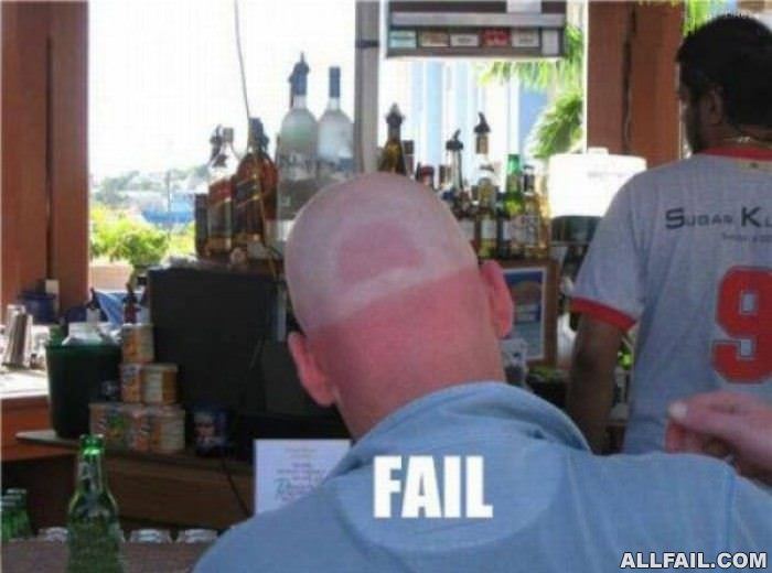 hat hair burn